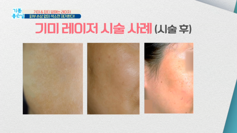 임이석테마피부과 기미를 없애는 법, 기미 레이저 전후 공개! MBC 기분좋은날 출연 관련 이미지 17