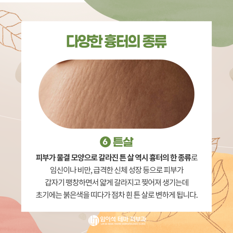 Acne Scars, Stretch Mark Treatment, Different Types of Scars, and Scar Removal and Treatment Methods image 4