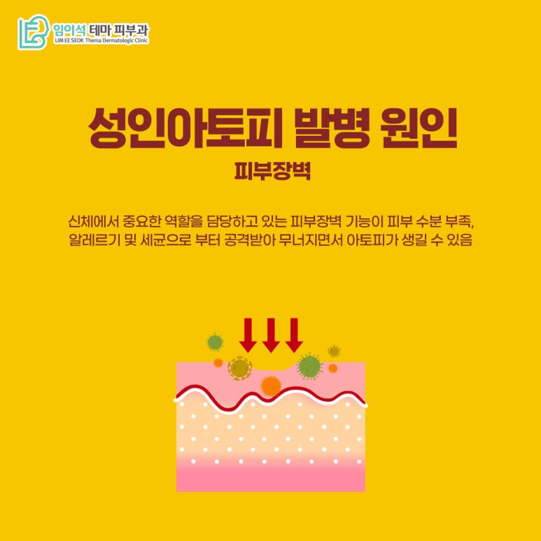 임이석피부과 성인아토피 피부염의 발병 원인과 치료법 관련 이미지 5