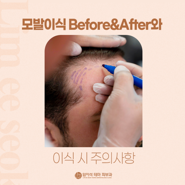모발이식 Before&After와 이식 시 주의사항 관련 이미지 2