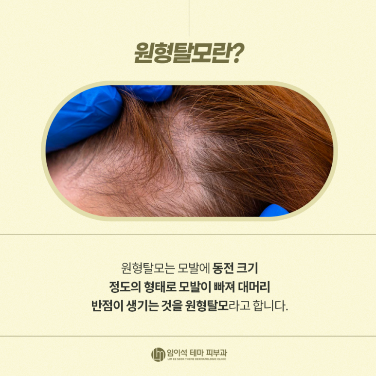 Alopecia Areata, M-Shaped Hair Loss Symptoms, and Self-Diagnosis Methods for Hair Loss image 6