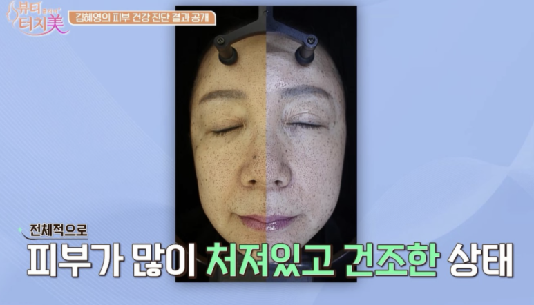 채널A 뷰티클리닉 터치미 9회~11회 사례로 알아보는 피부를 망치는 습관 모음집 [신사역 임이석테마피부과] 관련 이미지 6