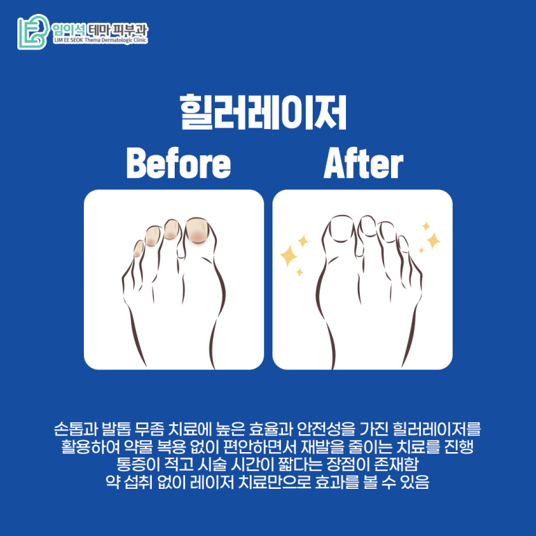 임이석 피부과 손발톱진균증 치료 레이저 힐러1064 관련 이미지 8