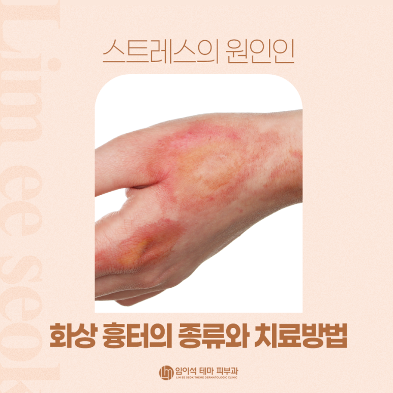 스트레스의 원인인 화상 흉터의 종류와 치료방법 관련 이미지 2