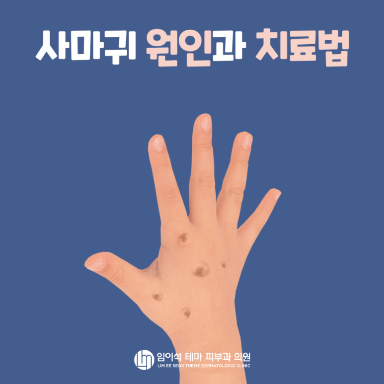 사마귀 원인과 치료법! 임이석 피부과에서 알려드립니다 관련 이미지 2
