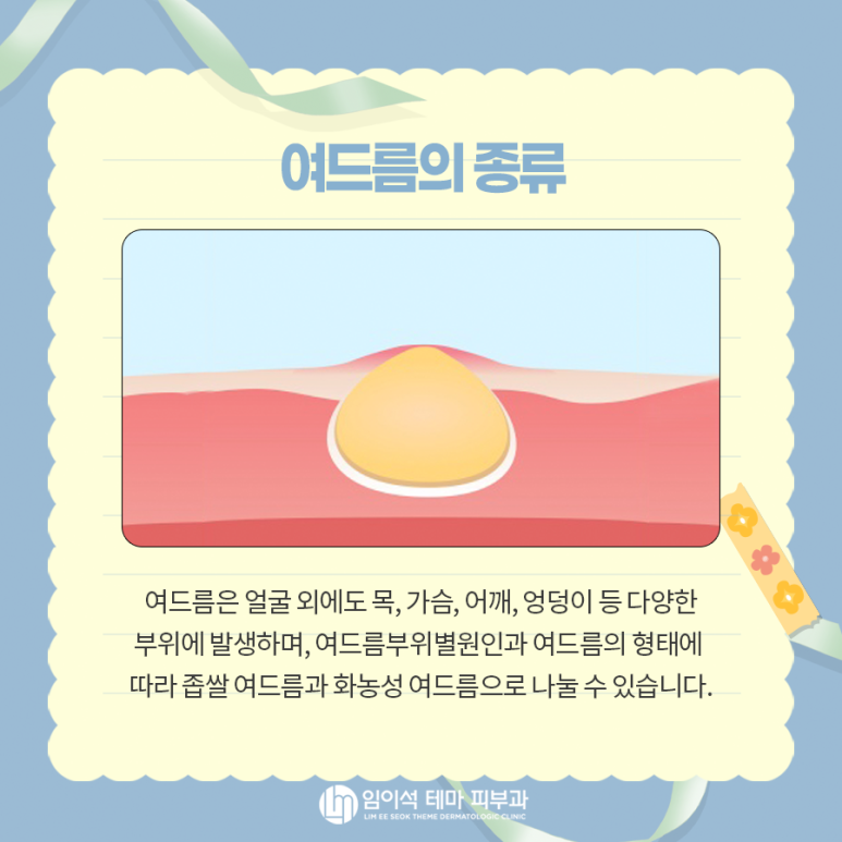 여드름의 종류, 원인, 치료, 흉터 관리법 관련 이미지 4
