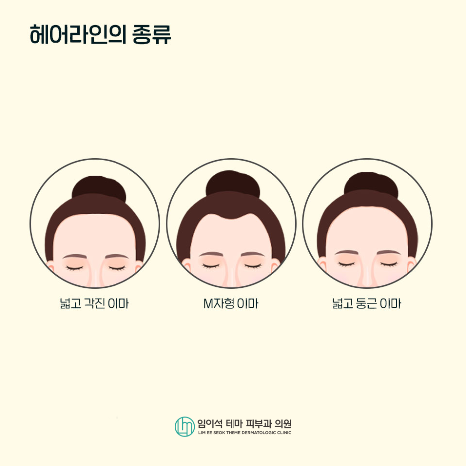 헤어라인 교정 방법은 무엇이 있을까요? 관련 이미지 4
