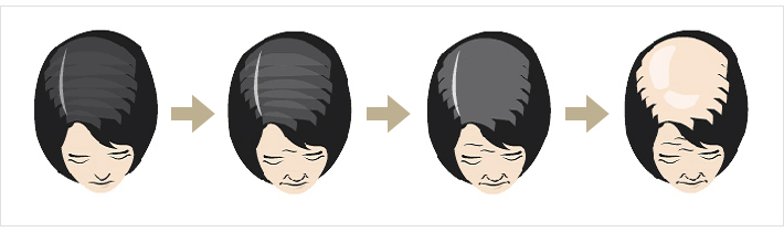 Why Does Hair Loss Occur? Hair Loss Prevention, Imi Seok Dermatology image 8