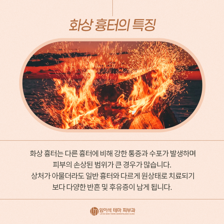 스트레스의 원인인 화상 흉터의 종류와 치료방법 관련 이미지 3