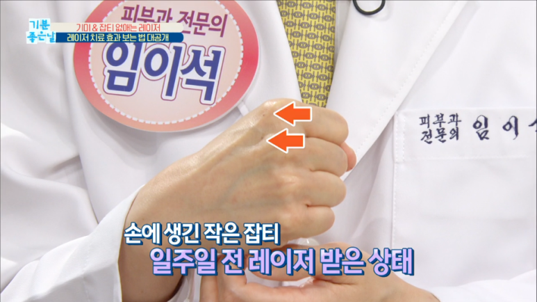 임이석테마피부과 기미를 없애는 법, 기미 레이저 전후 공개! MBC 기분좋은날 출연 관련 이미지 4