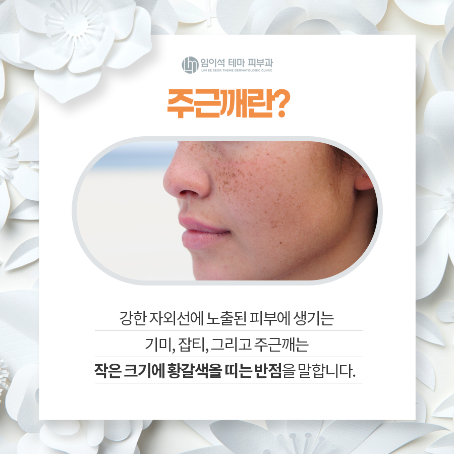 주근깨 개선을 위한 치료법 관련 이미지 3