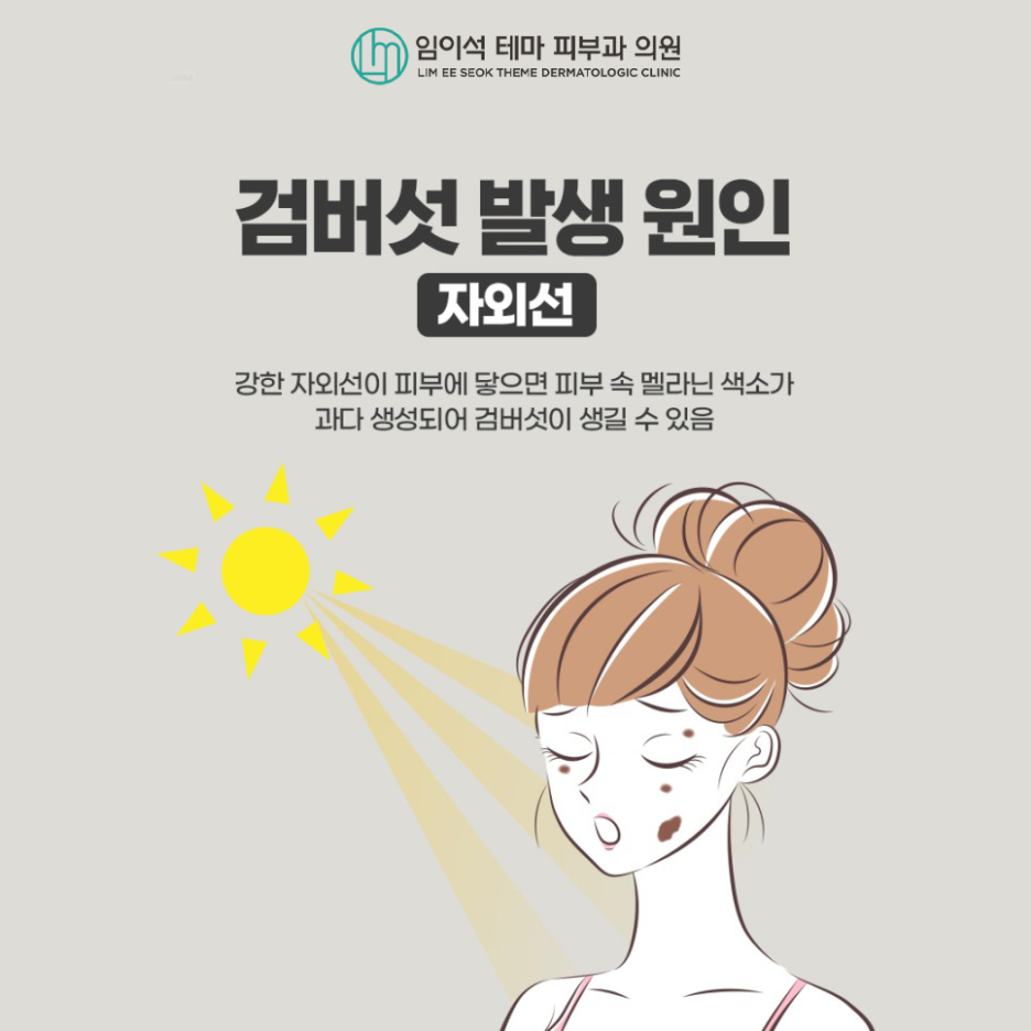 레이저를 이용한 검버섯 치료방법과 예방법 관련 이미지 4