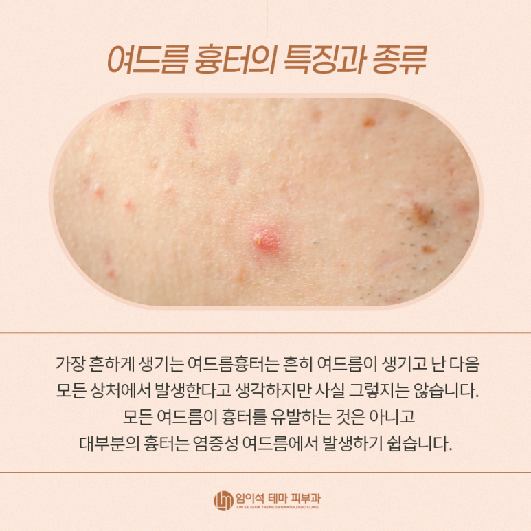 스트레스의 원인인 화상 흉터의 종류와 치료방법 관련 이미지 7