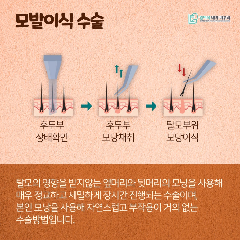 혹시, 나도 탈모일까? 신사피부과 탈모자가진단법 관련 이미지 10