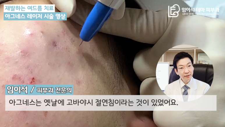 [Imi-seok Thema Dermatology YouTube Dr. Imi-seok Channel] Laser Treatment for Recurrent Acne image 3