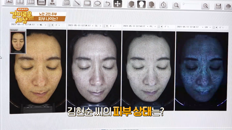 강남 피부과전문의 임이석, OBS [경이로운세상] 방송출연 관련 이미지 6