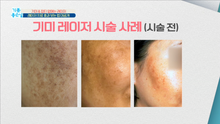 임이석테마피부과 기미를 없애는 법, 기미 레이저 전후 공개! MBC 기분좋은날 출연 관련 이미지 6