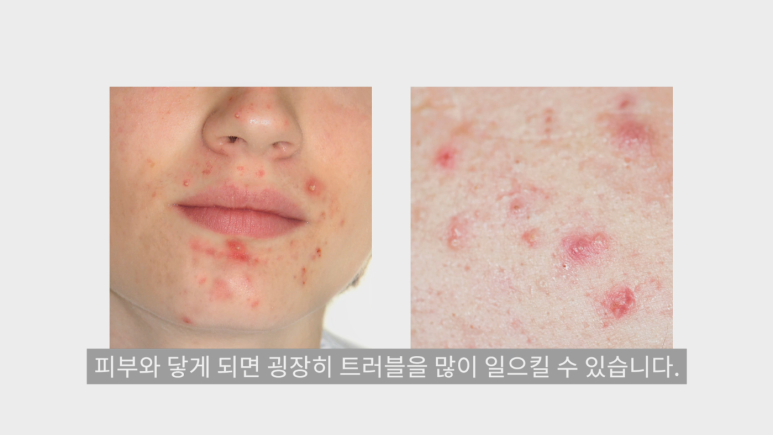[Imiseok Thema Dermatology YouTube Dr. Imiseok Channel] My skin stings and hurts around the mask! image 7