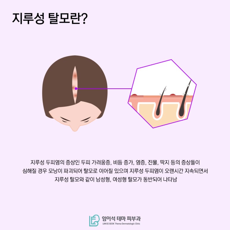 [임이석테마피부과] 지루성 두피염 방치하면 지루성 탈모된다!? 관련 이미지 4