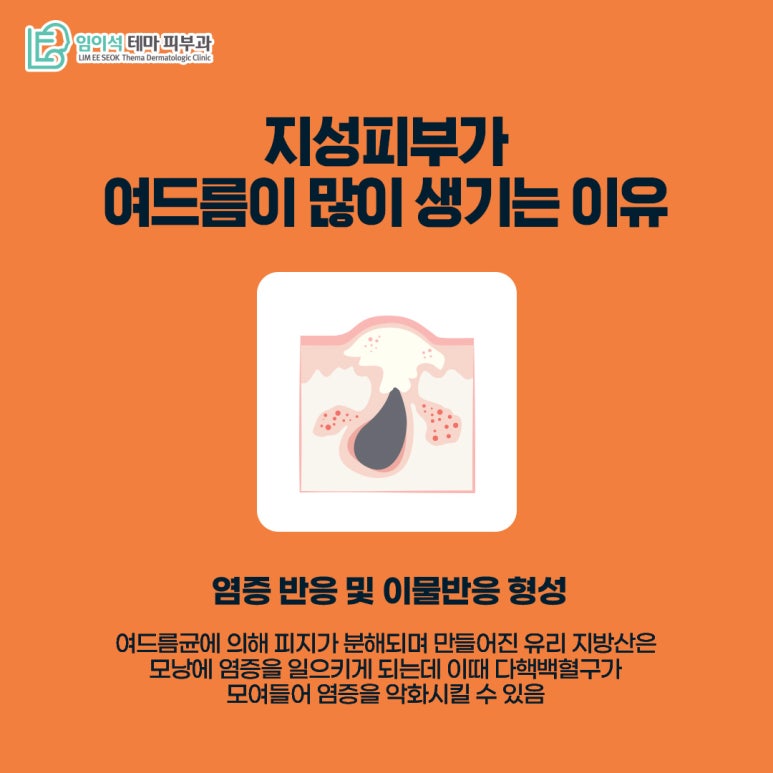 임이석테마피부과 피부 타입별 여드름관리법 <지성피부편> 관련 이미지 6
