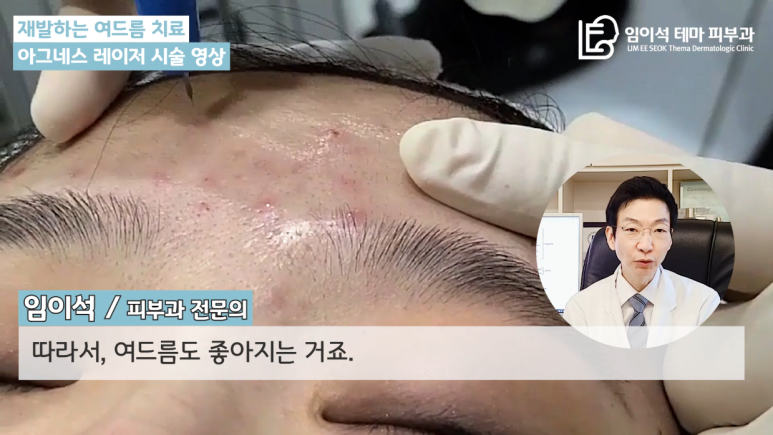[Imi-seok Thema Dermatology YouTube Dr. Imi-seok Channel] Laser Treatment for Recurrent Acne image 6