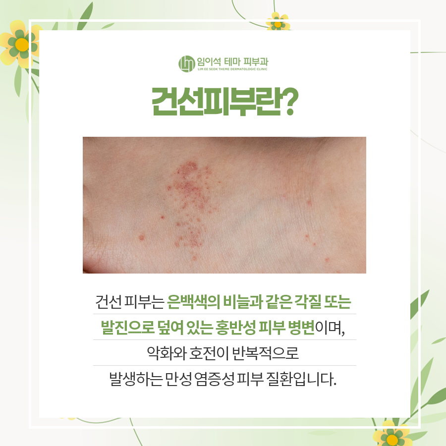 건조한 피부, 피부 건선이 생기는 이유와 치료 방법 관련 이미지 3