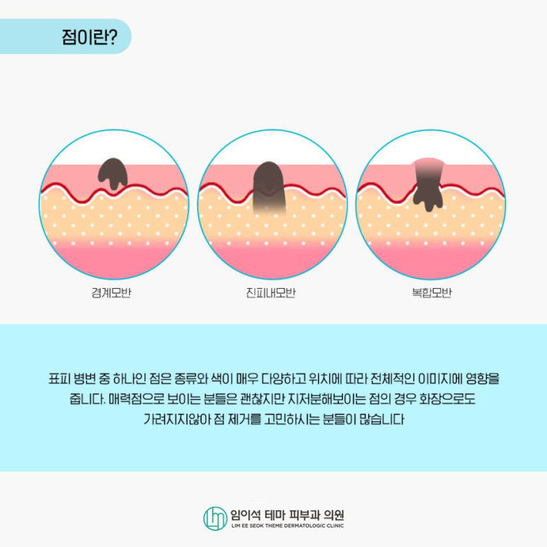 얼굴에 생기는 점, 사마귀, 한관종 치료방법 관련 이미지 3