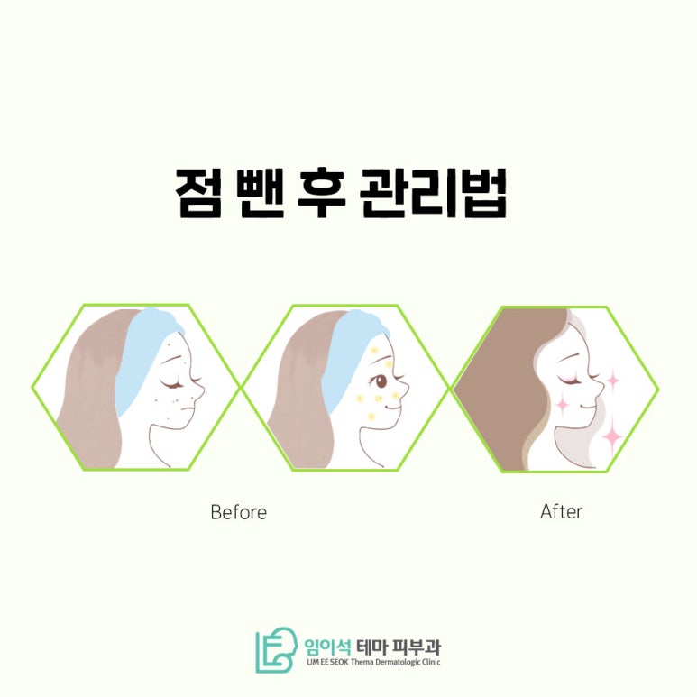 임이석테마피부과에서 알려드리는 점뺀 후 관리법 관련 이미지 2