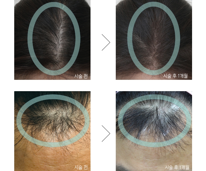 Hair Loss Treatment image 5