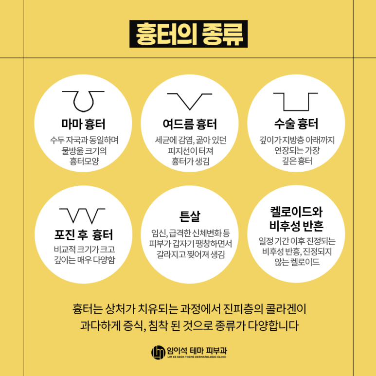 여드름흉터, 수술 흉터, 다양한 흉터 종류와 흉터제거 및 치료방법 관련 이미지 3