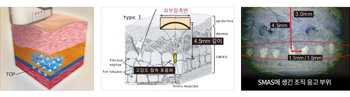 얼굴주름리프팅 울쎄라 임이석테마피부과 관련 이미지 3