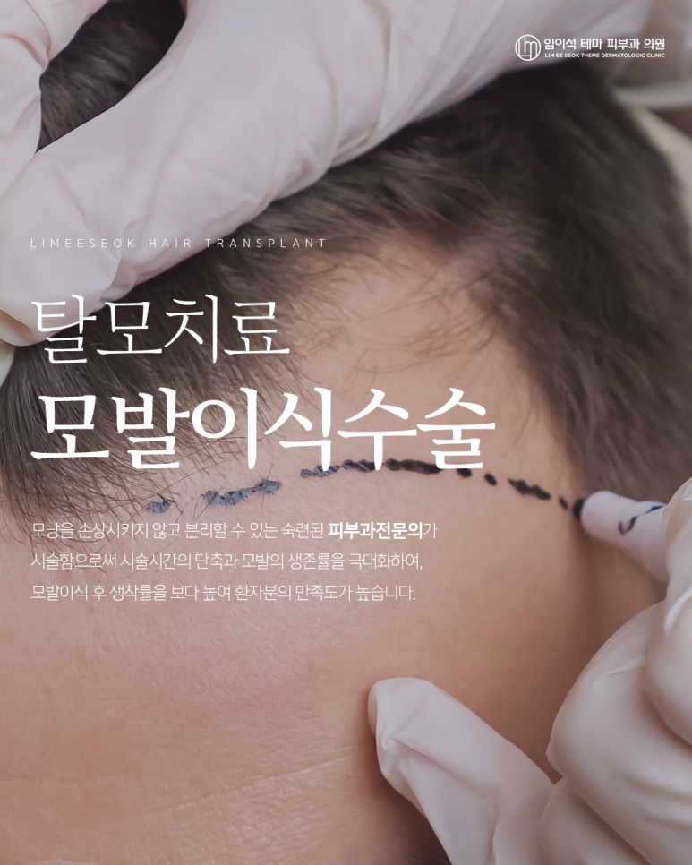 Gapsa Station Dermatology: Do You Really Need Hair Transplant Surgery for Hair Loss? image 1