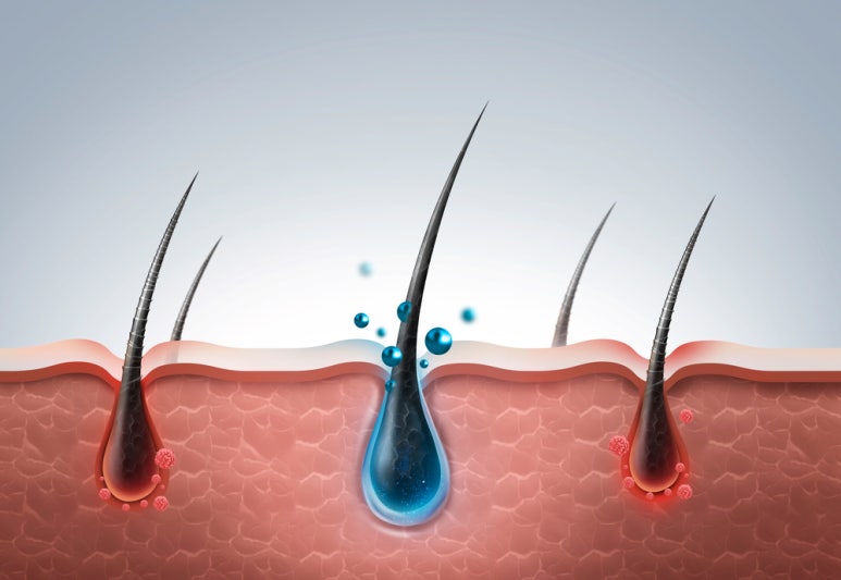 Male Pattern Hair Loss Treatment: Hair Loss Treatment Using Fat-Derived Stem Cells image 3