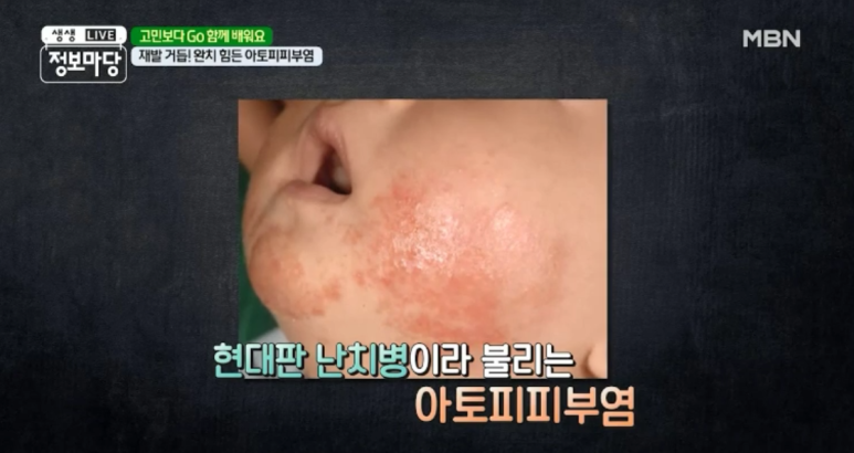 임이석 원장 "주위의 시선이 두려운 피부질환 - 아토피 피부염" MBN 생생정보마당 출연 관련 이미지 7