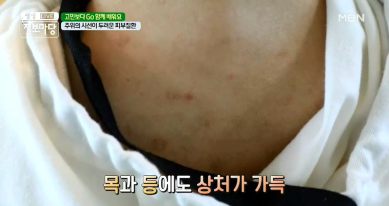임이석 원장 "주위의 시선이 두려운 피부질환 - 아토피 피부염" MBN 생생정보마당 출연 관련 이미지 3