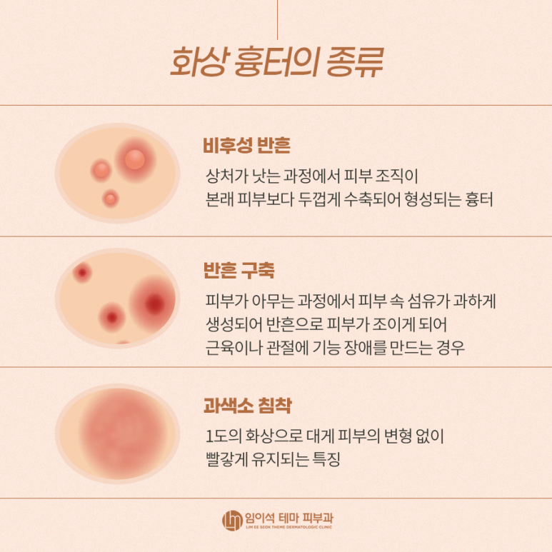 스트레스의 원인인 화상 흉터의 종류와 치료방법 관련 이미지 4