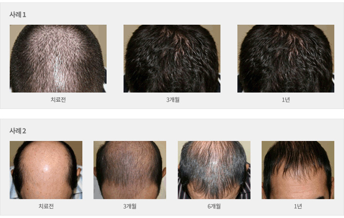 Why Does Hair Loss Occur? Hair Loss Prevention, Imi Seok Dermatology image 9