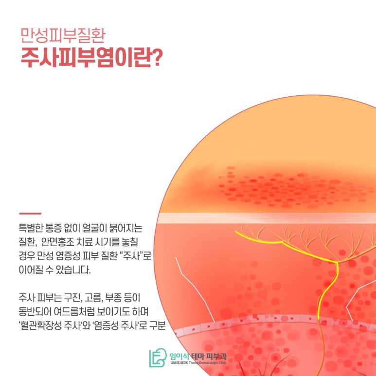 신사 피부과 만성피부질환, 주사피부염 치료 방법 관련 이미지 3