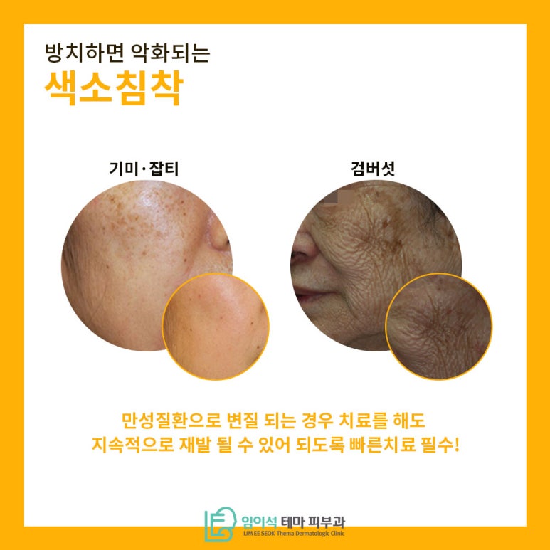 기미잡티, 색소침착 개선을 위한 레이저토닝 치료법 관련 이미지 4