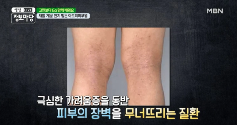 임이석 원장 "주위의 시선이 두려운 피부질환 - 아토피 피부염" MBN 생생정보마당 출연 관련 이미지 8