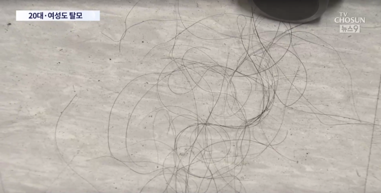 Director Im Yi-seok: "One in Four Hair Loss Patients Is in Their 20s or 30s" Appearance on TV Chosun News 9 image 5