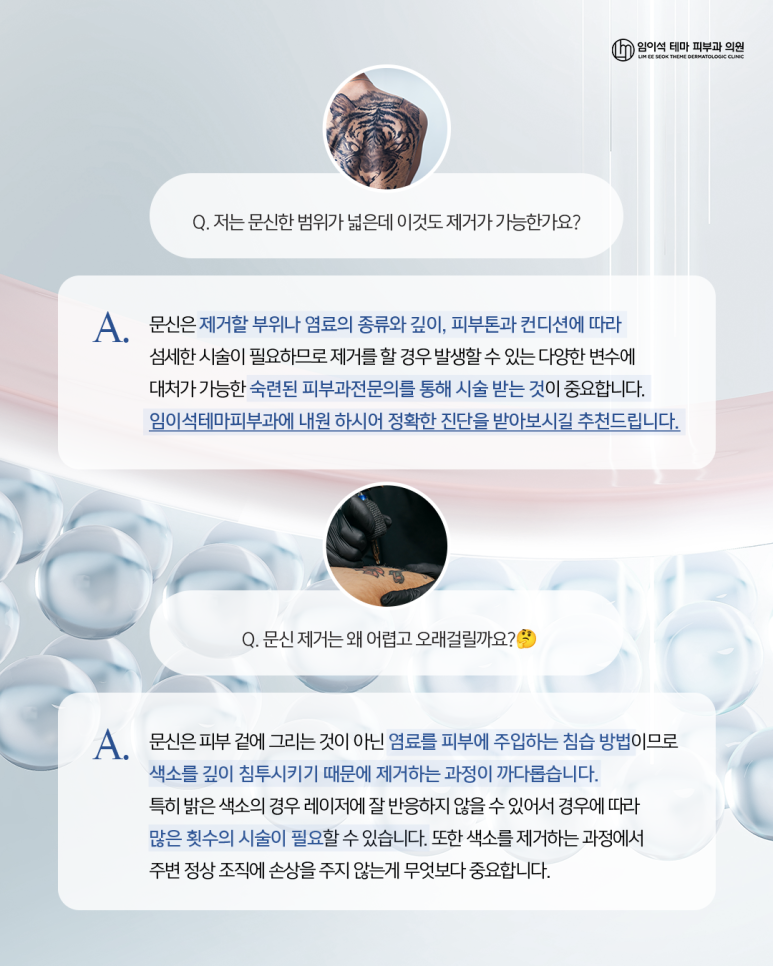 신사역피부과추천, 유행지난 반영구&middot;문신제거 방법은? 관련 이미지 3