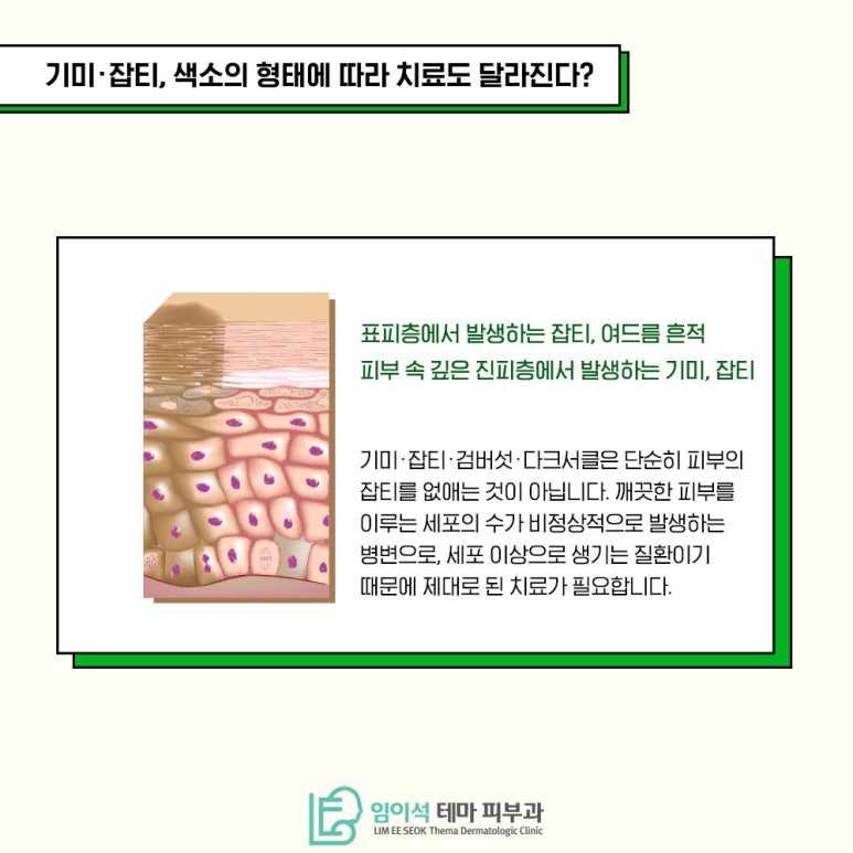 기미 잡티 종류와 원인과 치료방법 관련 이미지 3