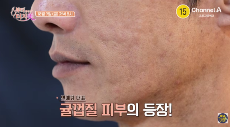 채널A 뷰티클리닉 터치미 9회~11회 사례로 알아보는 피부를 망치는 습관 모음집 [신사역 임이석테마피부과] 관련 이미지 11