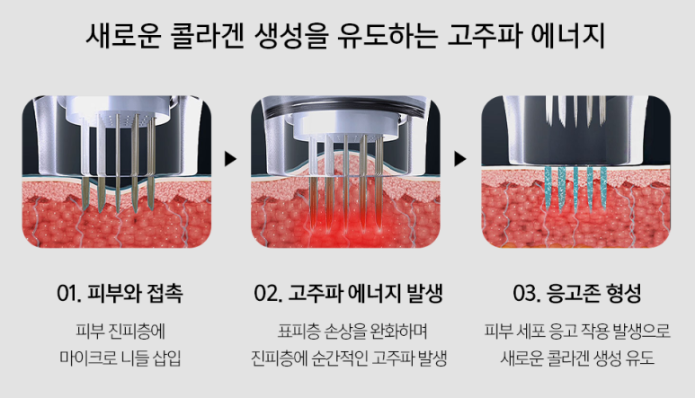 발렌타인데이 전, 간단하게 할 수 있는 시술 - 포텐자, 보톡스리프팅 관련 이미지 2