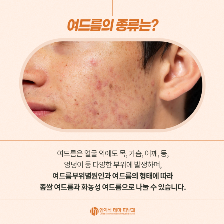 여드름의 종류, 원인, 치료, 흉터 관리법 관련 이미지 4