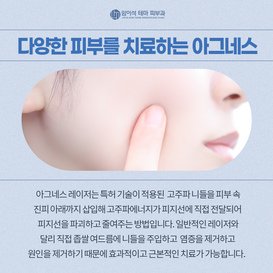 Differences Between Syringoma and Milia and How to Treat Them image 6