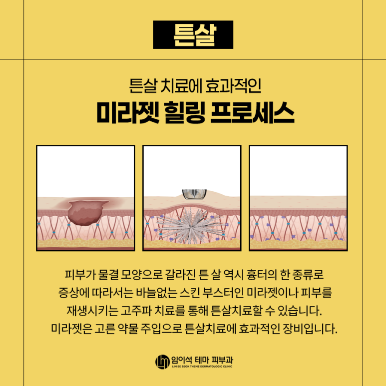 여드름흉터, 수술 흉터, 다양한 흉터 종류와 흉터제거 및 치료방법 관련 이미지 4