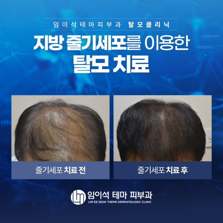 Male Pattern Hair Loss Treatment: Hair Loss Treatment Using Fat-Derived Stem Cells image 4