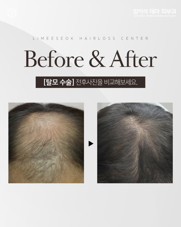 Gapsa Station Dermatology: Do You Really Need Hair Transplant Surgery for Hair Loss? image 4